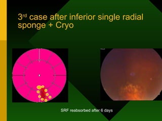 3 rd  case after inferior single radial sponge + Cryo SRF reabsorbed after 6 days 