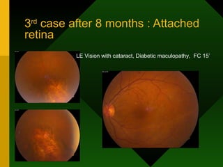 3 rd  case after 8 months : Attached retina LE Vision with cataract, Diabetic maculopathy,  FC 15’ 