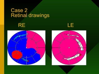 Case 2  Retinal drawings    RE  LE 