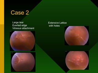 Case 2 Large tear Everted edge Vitreous attachment Extensive Lattice with holes 
