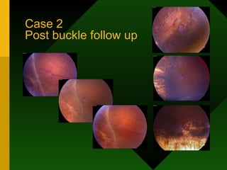 Case 2  Post buckle follow up 
