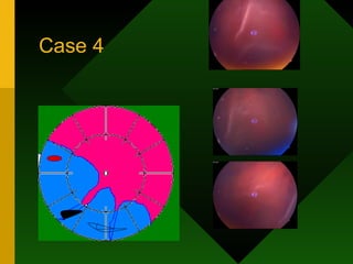 Case 4 
