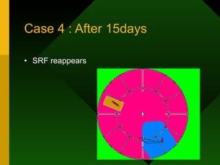 Case 4 : After 15days SRF reappears 