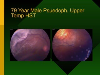 79 Year Male Psuedoph. Upper Temp HST 