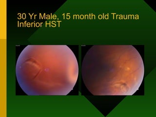 30 Yr Male, 15 month old Trauma Inferior HST  