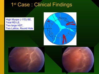 1 st  Case : Clinical Findings High Myope (-17D) BE,  Total RD LE,  Two large HST,  Two Lattice, Round Hole 