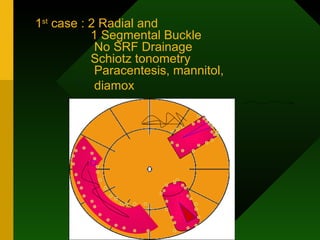 1 st  case : 2 Radial and    1 Segmental Buckle   No SRF Drainage   Schiotz tonometry   Paracentesis, mannitol,    diamox   