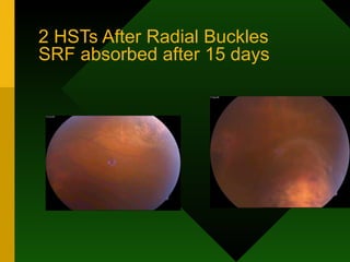 2 HSTs After Radial Buckles SRF absorbed after 15 days 