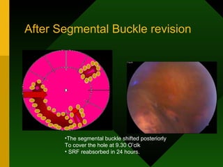 After Segmental Buckle revision The segmental buckle shifted posteriorly To cover the hole at 9.30 O’clk SRF reabsorbed in 24 hours. 