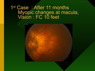 1 st  Case  : After 11 months Myopic changes at macula, Vision : FC 10 feet 