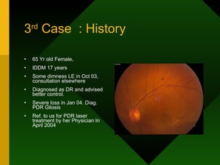 3 rd  Case  : History 65 Yr old Female,  IDDM 17 years Some dimness LE in Oct 03, consultation elsewhere Diagnosed as DR and advised better control. Severe loss in Jan 04. Diag. PDR Gliosis  Ref. to us for PDR laser treatment by her Physician In April 2004 