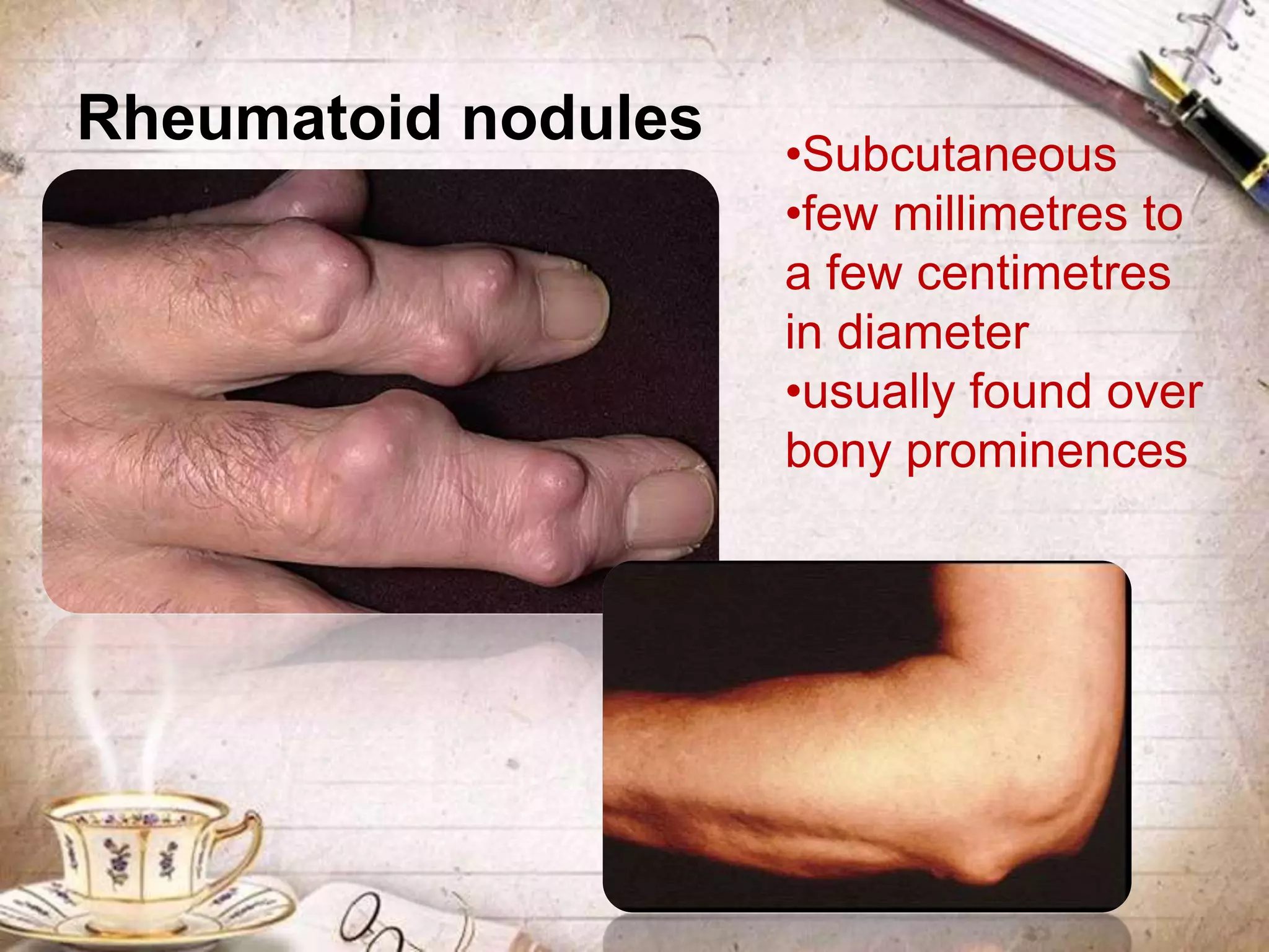 Rheumatoid nodules •Subcutaneous
•few millimetres to
a few centimetres
in diameter
•usually found over
bony prominences
 
