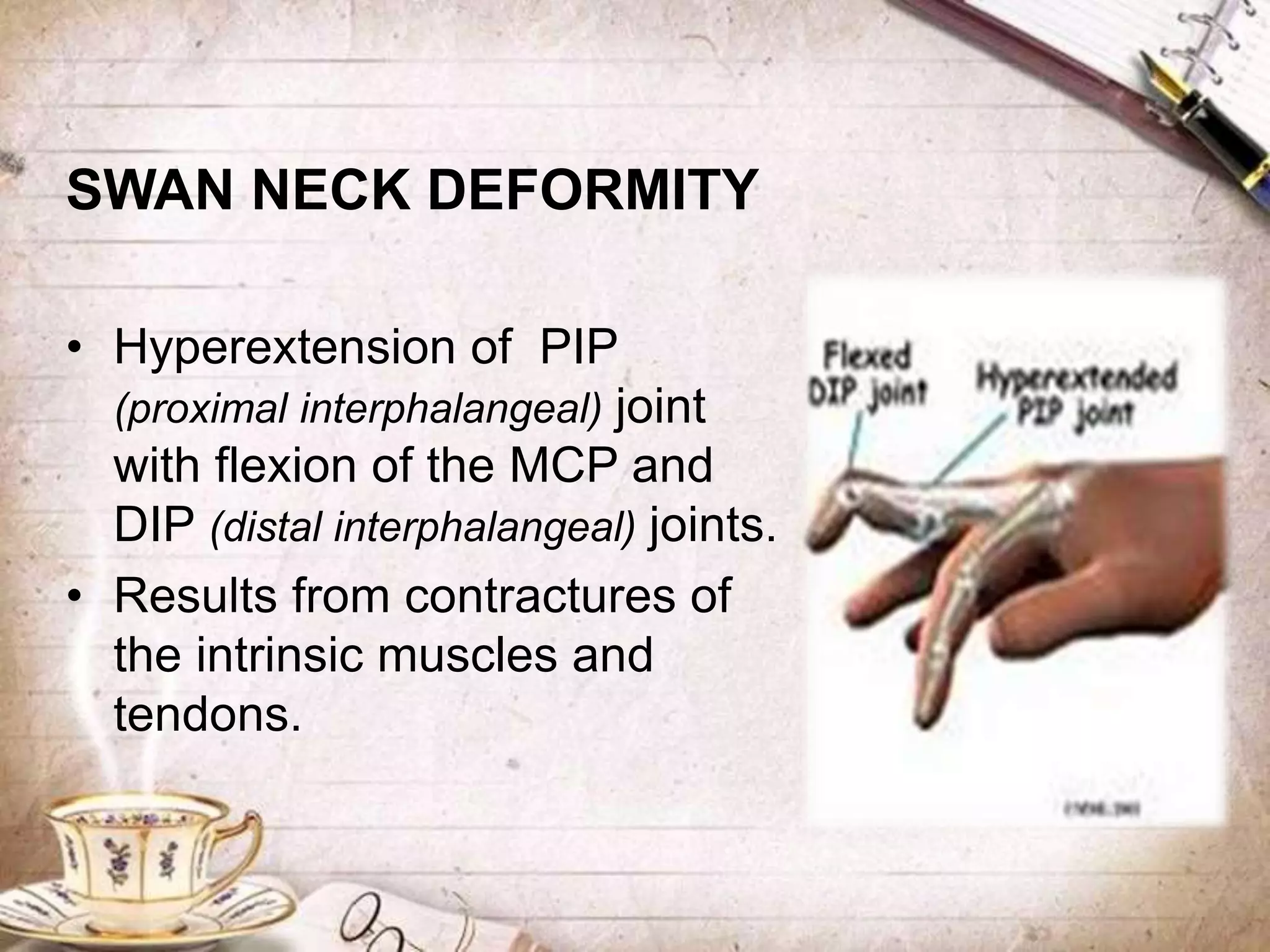 SWAN NECK DEFORMITY
• Hyperextension of PIP
(proximal interphalangeal) joint
with flexion of the MCP and
DIP (distal interphalangeal) joints.
• Results from contractures of
the intrinsic muscles and
tendons.
 