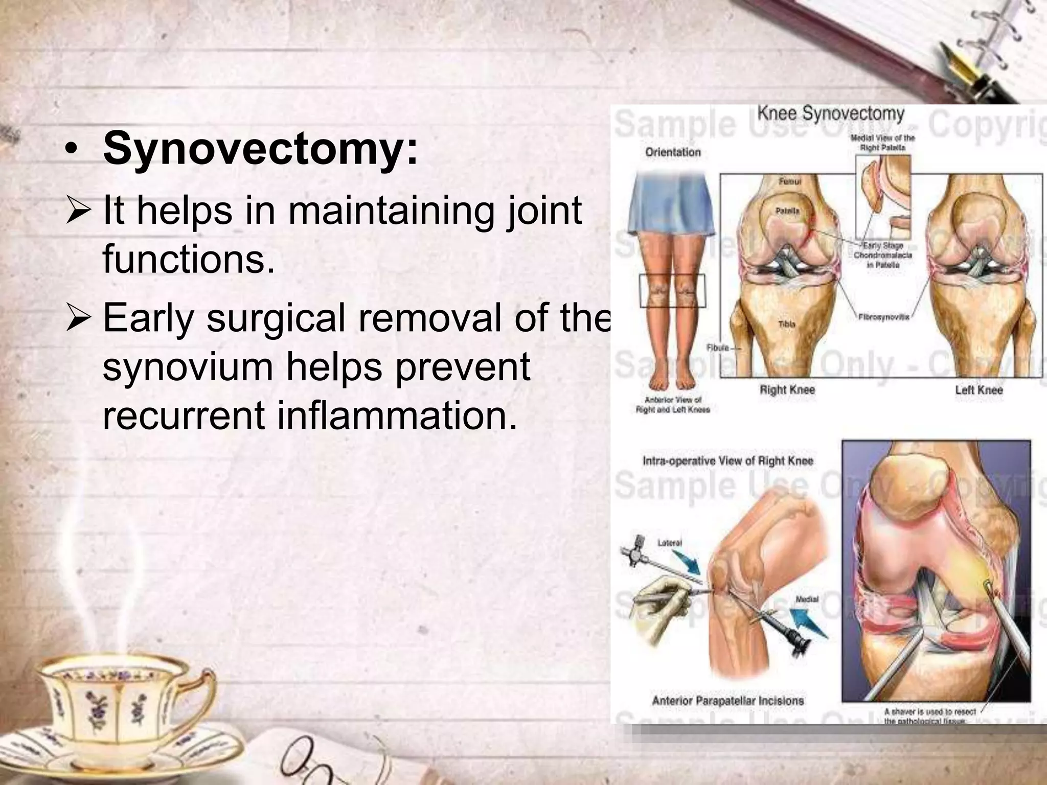 • Synovectomy:
 It helps in maintaining joint
functions.
 Early surgical removal of the
synovium helps prevent
recurrent inflammation.
 