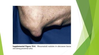 Olol Rheumatology Rhematoid arthritis by dr shyam sunder sharma | PPTX