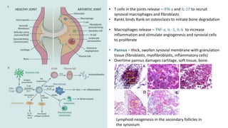 • T cells in the joints release – IFN-y and IL-17 to recruit
synovial macrophages and fibroblasts
• RankL binds Rank on osteoclasts to initiate bone degradation
• Macrophages release – TNF-a, IL- 1, IL-6 to increase
inflammation and stimulate angiogenesis and synovial cells
to proliferate
• Pannus – thick, swollen synovial membrane with granulation
tissue (fibroblasts, myofibroblasts, inflammatory cells)
• Overtime pannus damages cartilage, soft tissue, bone.
Lymphoid neogenesis in the secondary follicles in
the synovium
 