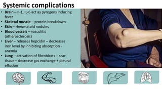 Systemic complications
• Brain – Il-1, IL-6 act as pyrogens inducing
fever
• Skeletal muscle – protein breakdown
• Skin – rheumatoid nodules
• Blood vessels – vasculitis
(atherosclerosis)
• Liver – releases hepcidin – decreases
iron level by inhibiting absorption -
anemia
• Lung – activation of fibroblasts – scar
tissue – decrease gas exchange + pleural
effusion
 