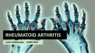 RHEUMATOID ARTHRITIS
Lasha Chkhikvadze USMD 2024
 
