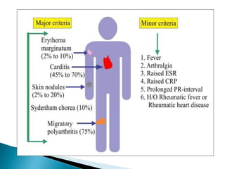 Rhd Crieteira Rheumatic Heart disease | PPTX