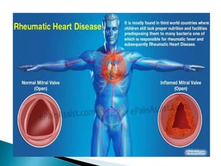 Rhd Crieteira Rheumatic Heart disease | PPTX