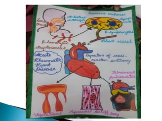 Patofisiologi Rhd Rheumatic Heart disease | PPTX