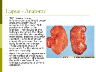 Lupus - Anatomy
 SLE causes tissue
inflammation and blood vessel
problems pretty much
anywhere in the body. SLE
particularly affects the
kidneys. The tissues of the
kidneys, including the blood
vessels and the surrounding
membrane, become inflamed
(swollen), and deposits of
chemicals produced by the
body form in the kidneys.
These changes make it
impossible for the kidneys to
function normally.
 Note the granular appearance
of the cortex of these lupus
affected kidneys – it’s across
the entire surface of both
kidneys suggesting a chronic
condition.
 