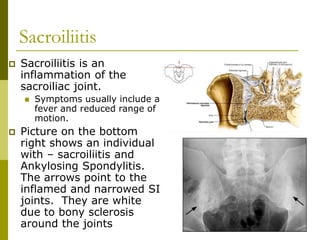 Sacroiliitis
 Sacroiliitis is an
inflammation of the
sacroiliac joint.
 Symptoms usually include a
fever and reduced range of
motion.
 Picture on the bottom
right shows an individual
with – sacroiliitis and
Ankylosing Spondylitis.
The arrows point to the
inflamed and narrowed SI
joints. They are white
due to bony sclerosis
around the joints
 