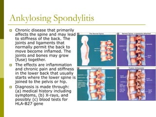 Ankylosing Spondylitis
 Chronic disease that primarily
affects the spine and may lead
to stiffness of the back. The
joints and ligaments that
normally permit the back to
move become inflamed. The
joints and bones may grow
(fuse) together.
 The effects are inflammation
and chronic pain and stiffness
in the lower back that usually
starts where the lower spine is
joined to the pelvis or hip.
 Diagnosis is made through:
(a) medical history including
symptoms, (b) X-rays, and
possibly (c) blood tests for
HLA-B27 gene
 