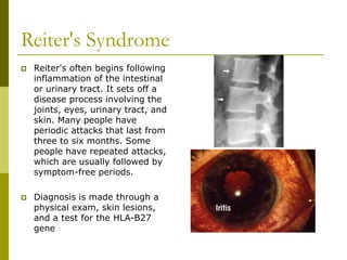 Reiter's Syndrome
 Reiter's often begins following
inflammation of the intestinal
or urinary tract. It sets off a
disease process involving the
joints, eyes, urinary tract, and
skin. Many people have
periodic attacks that last from
three to six months. Some
people have repeated attacks,
which are usually followed by
symptom-free periods.
 Diagnosis is made through a
physical exam, skin lesions,
and a test for the HLA-B27
gene
 