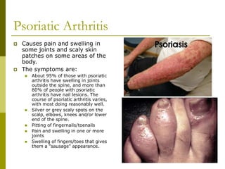 Psoriatic Arthritis
 Causes pain and swelling in
some joints and scaly skin
patches on some areas of the
body.
 The symptoms are:
 About 95% of those with psoriatic
arthritis have swelling in joints
outside the spine, and more than
80% of people with psoriatic
arthritis have nail lesions. The
course of psoriatic arthritis varies,
with most doing reasonably well.
 Silver or grey scaly spots on the
scalp, elbows, knees and/or lower
end of the spine.
 Pitting of fingernails/toenails
 Pain and swelling in one or more
joints
 Swelling of fingers/toes that gives
them a "sausage" appearance.
 