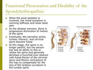Functional Presentation and Disability of the
Spondylarthropathies
 When the axial skeleton is
involved, the initial symptom is
morning stiffness and lower back
pain
 As the disease worsens, there is
progressive diminution of motion
of the spine
 Eventually, the sacroiliac joints,
lumbar, thoracic, and cervical
spine become fused
 At this stage, the spine is no
longer painful, but the person
has lost all ability to flex or
rotate the spine and generally
develops a hunched-over posture
with fused flexion of the cervical
spine and flexion contracture of
the hips to compensate for the
loss of the lordosis curvature in
the lumbar spine
 