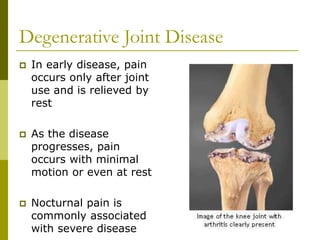 Degenerative Joint Disease
 In early disease, pain
occurs only after joint
use and is relieved by
rest
 As the disease
progresses, pain
occurs with minimal
motion or even at rest
 Nocturnal pain is
commonly associated
with severe disease
 