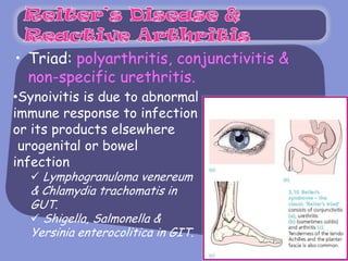 • Triad: polyarthritis, conjunctivitis &
  non-specific urethritis.
•Synoivitis is due to abnormal
immune response to infection
or its products elsewhere
 urogenital or bowel
infection
   Lymphogranuloma venereum
  & Chlamydia trachomatis in
  GUT.
   Shigella, Salmonella &
  Yersinia enterocolitica in GIT.
 