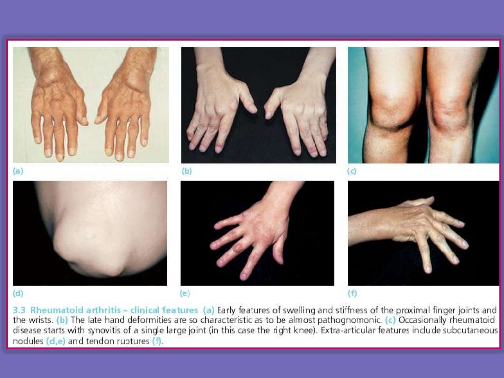 Rheumatic disorders summary