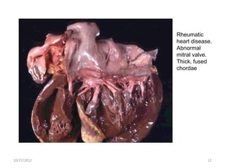 Rheumatic
             heart disease.
             Abnormal
             mitral valve.
             Thick, fused
             chordae




10/27/2012               12
 