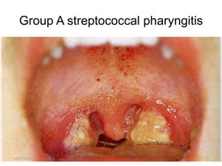 Group A streptococcal pharyngitis




10/27/2012                             7
 