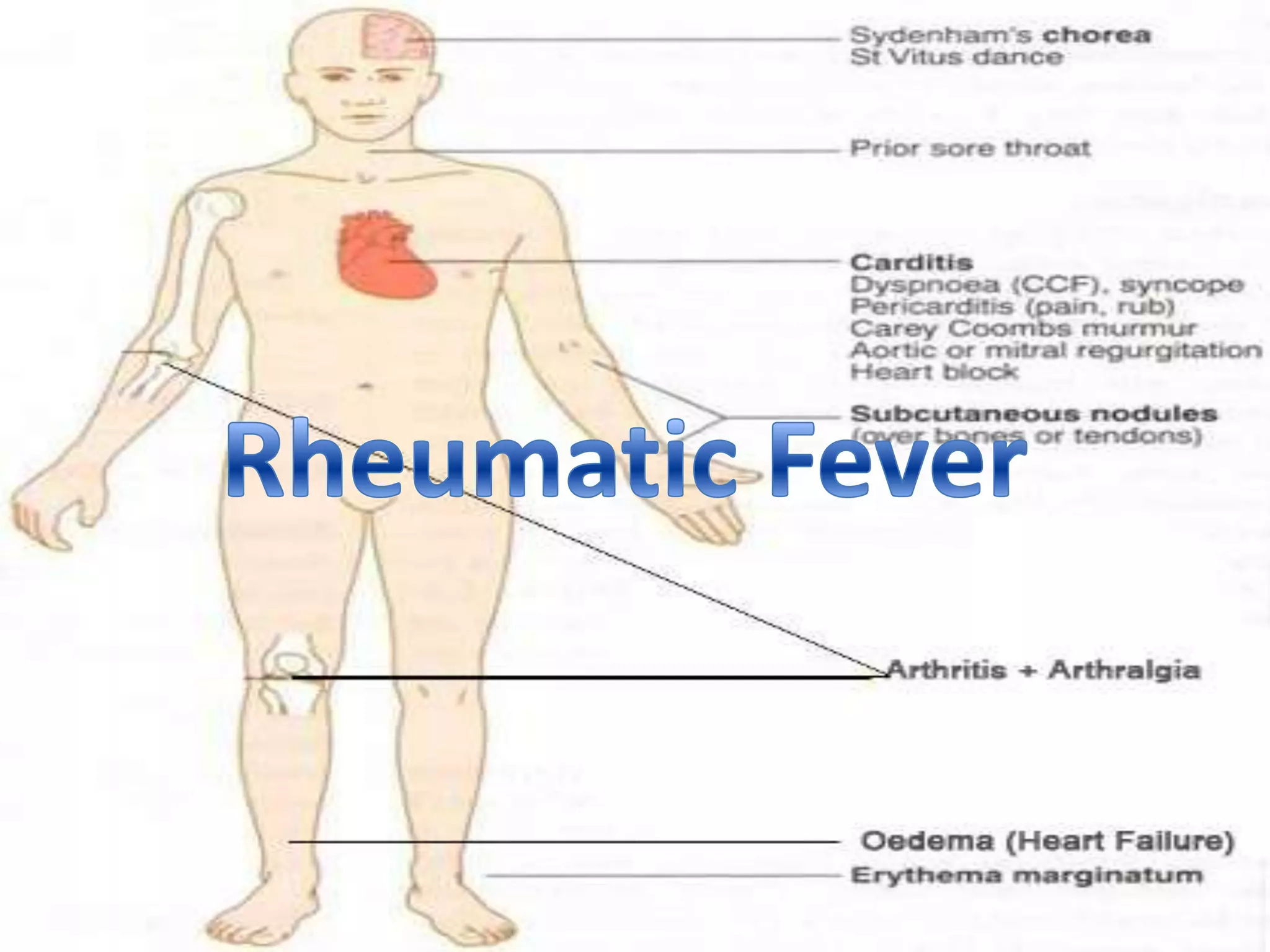 Rheumatic Fever | PPTX