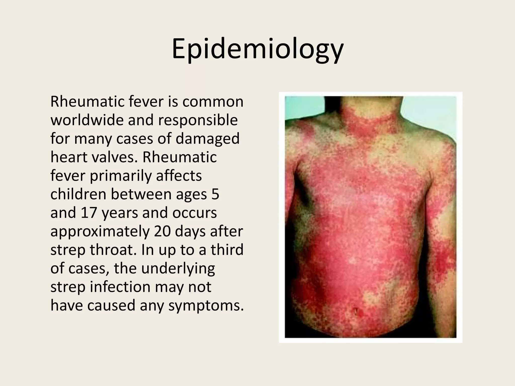 Rheumatic Fever | PPTX