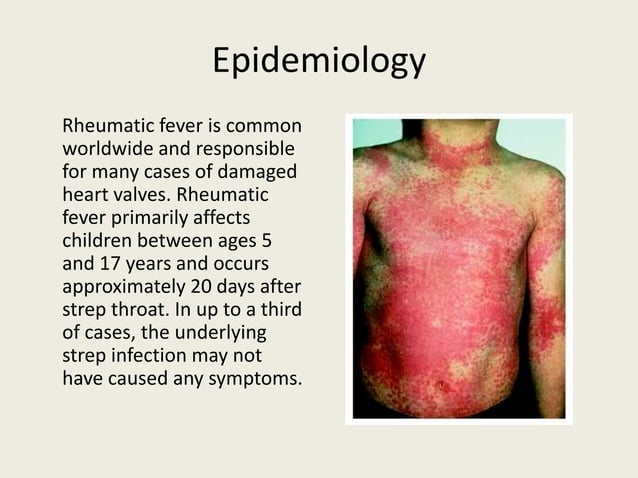 Rheumatic Fever | PPT