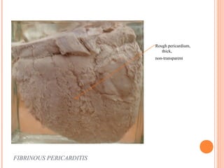 FIBRINOUS PERICARDITIS 
Rough pericardium, 
thick, 
non-transparent 
 