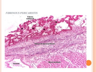 FIBRINOUS PERICARDITIS 
 