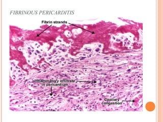 FIBRINOUS PERICARDITIS 
 