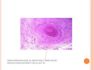 IMMUNOPATHOLOGICAL PROCESSES : RHEUMATIC 
GRANULOMA(ASCHOFF-TALALAEV’S) 
 