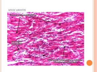 MYOCARDITIS 
 