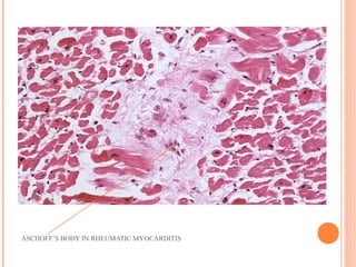 ASCHOFF’S BODY IN RHEUMATIC MYOCARDITIS 
 