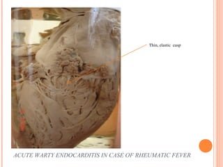 Thin, elastic cusp 
ACUTE WARTY ENDOCARDITIS IN CASE OF RHEUMATIC FEVER 
 