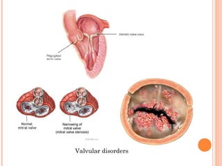 Valvular disorders 
 