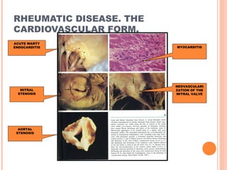 RHEUMATIC DISEASE. THE 
CARDIOVASCULAR FORM. 
ACUTE WARTY 
ENDOCARDITIS MYOCARDITIS 
NEOVASCULARI 
ZATION OF THE 
MITRAL VALVE 
MITRAL 
STENOSIS 
AORTAL 
STENOSIS 
 