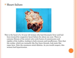  Heart failure 
This is the heart of a 44 year old woman who had rheumatic fever and had 
been treated for congestive heart failure for about one year. There is 
extreme fibrosis of the mitral valve with fusion of commissures and 
rigidity of the leaflets, leading to both stenosis and insufficiency. Note that 
the cordae, which are normally like fine linen threads, look more like 
ropes here. Note the enormous atrial dilation. As you would suspect, this 
woman had hypertension. 
 