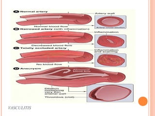 VASCULITIS 
 